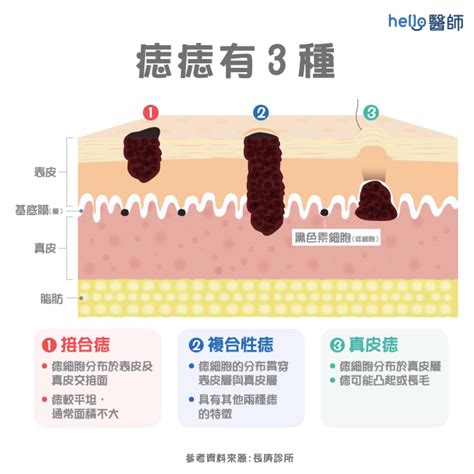 突出來的痣|痣變大、痣多或長毛會變皮膚癌？認識痣的形成與原因